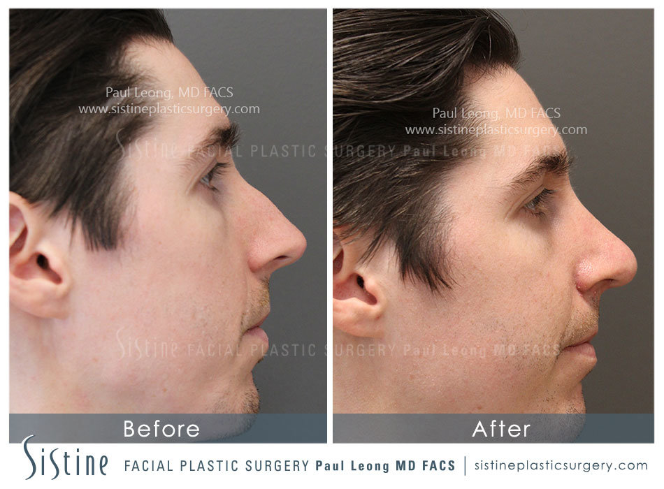 Rhinoplasty Before and After | Leong Facial Plastic Surgery