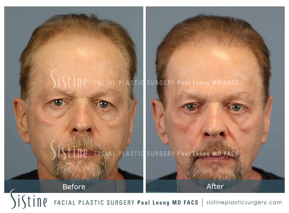 Hair Transplant Before and After | Leong Facial Plastic Surgery