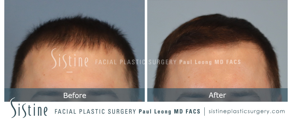 Hair Transplant Before and After | Leong Facial Plastic Surgery