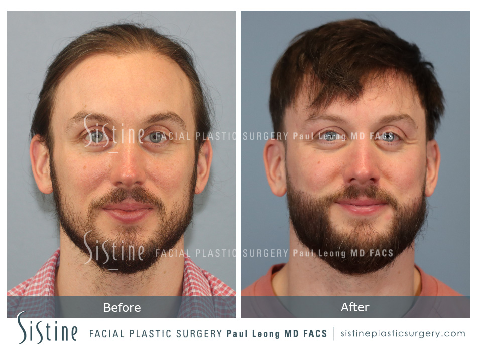 Hair Transplant Before and After | Leong Facial Plastic Surgery