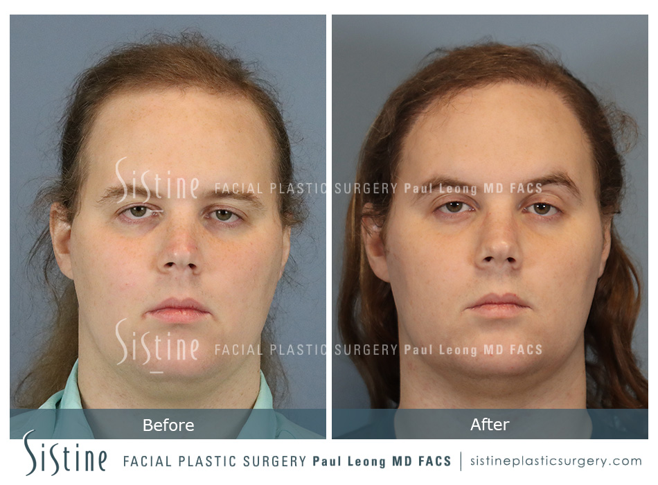 Hair Transplant Before and After | Leong Facial Plastic Surgery