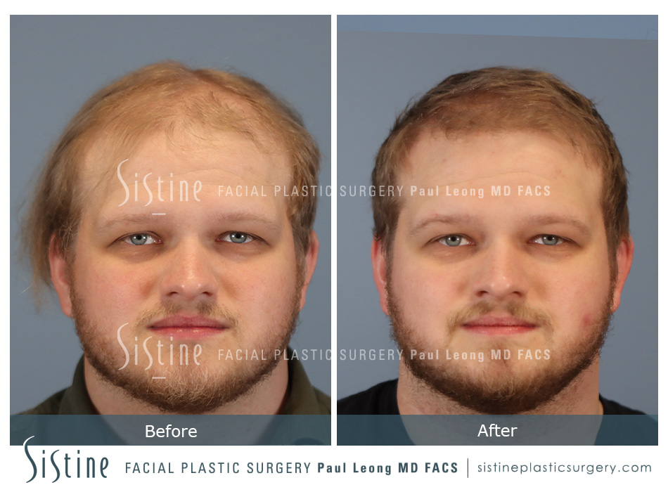 Hair Transplant Before and After | Leong Facial Plastic Surgery