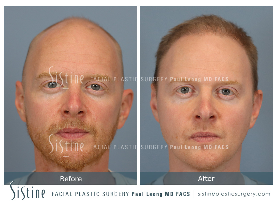 Hair Transplant Before and After | Leong Facial Plastic Surgery