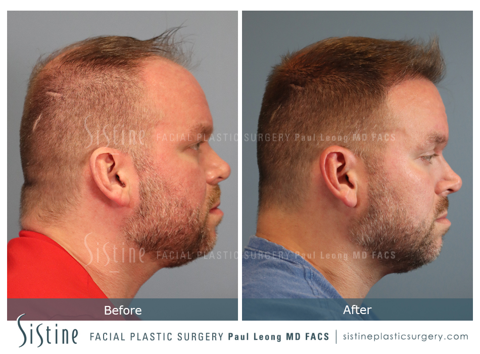 Hair Transplant Before and After | Leong Facial Plastic Surgery