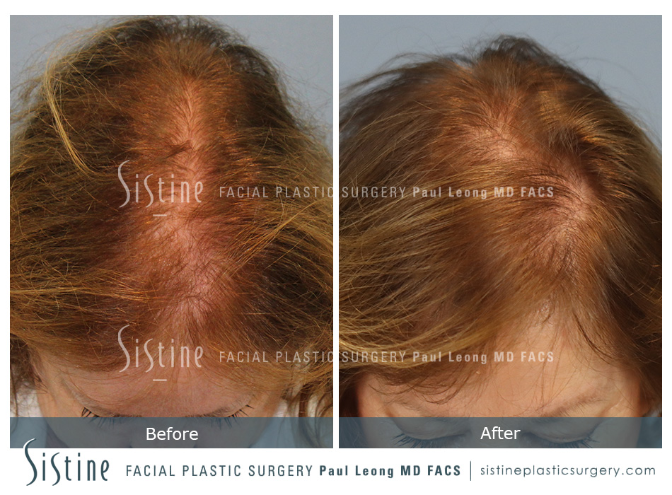 Hair Transplant Before and After | Leong Facial Plastic Surgery