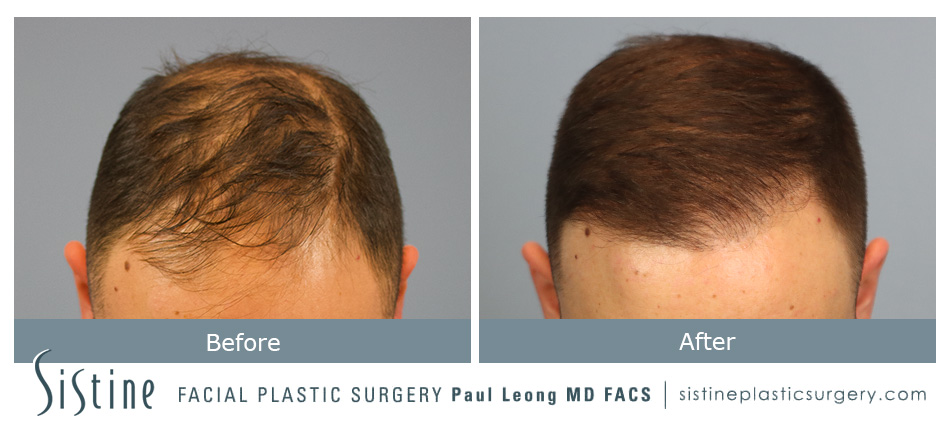 Hair Transplant Before and After | Leong Facial Plastic Surgery