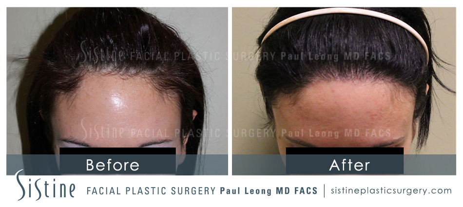 Hair Transplant Before and After | Leong Facial Plastic Surgery