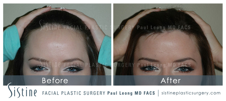 Hair Transplant Before and After | Leong Facial Plastic Surgery