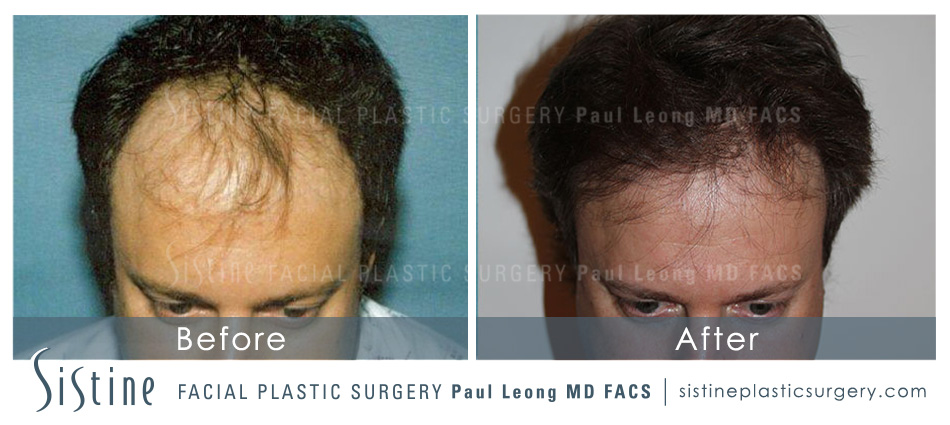 Hair Transplant Before and After | Leong Facial Plastic Surgery