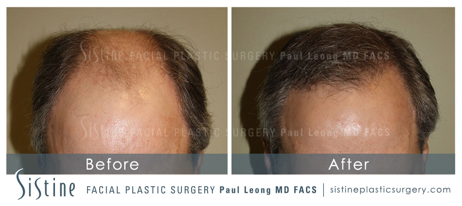 Hair Transplant Before and After | Leong Facial Plastic Surgery