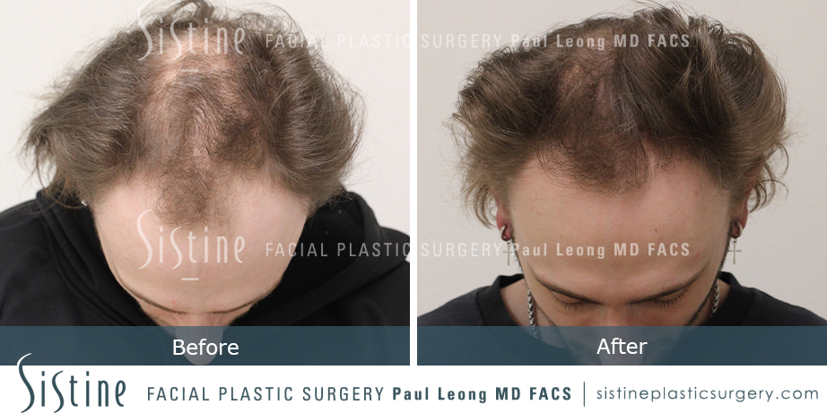 Hair Transplant Before and After | Leong Facial Plastic Surgery