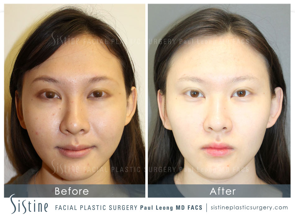 Asian Non Surgical Innovations Before and After | Leong Facial Plastic Surgery