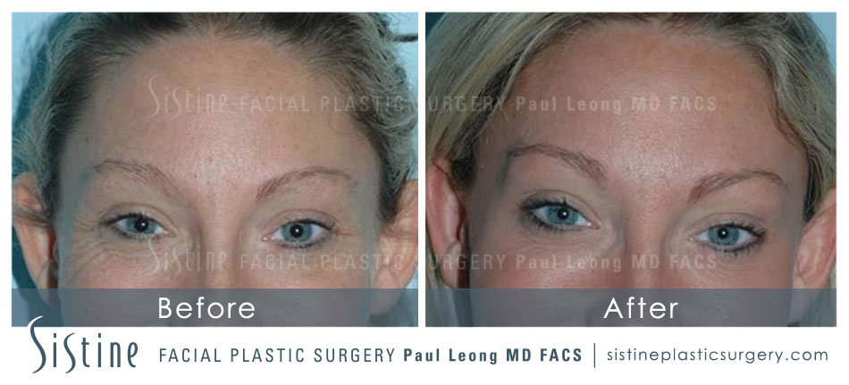 Botox Cosmetic Dysport Before and After | Leong Facial Plastic Surgery