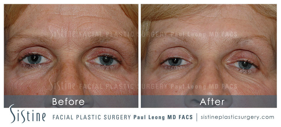 Botox Cosmetic Dysport Before and After | Leong Facial Plastic Surgery