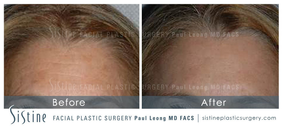 Botox Cosmetic Dysport Before and After | Leong Facial Plastic Surgery