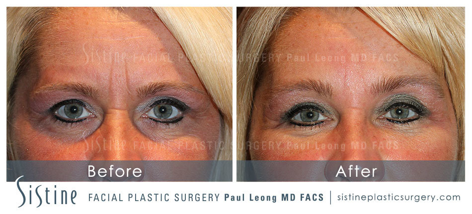 Botox Cosmetic Dysport Before and After | Leong Facial Plastic Surgery