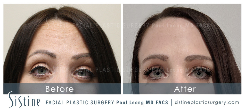 Botox Cosmetic Dysport Before and After | Leong Facial Plastic Surgery