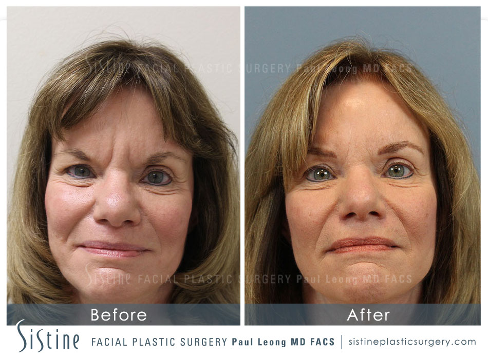 Botox Cosmetic Dysport Before and After | Leong Facial Plastic Surgery