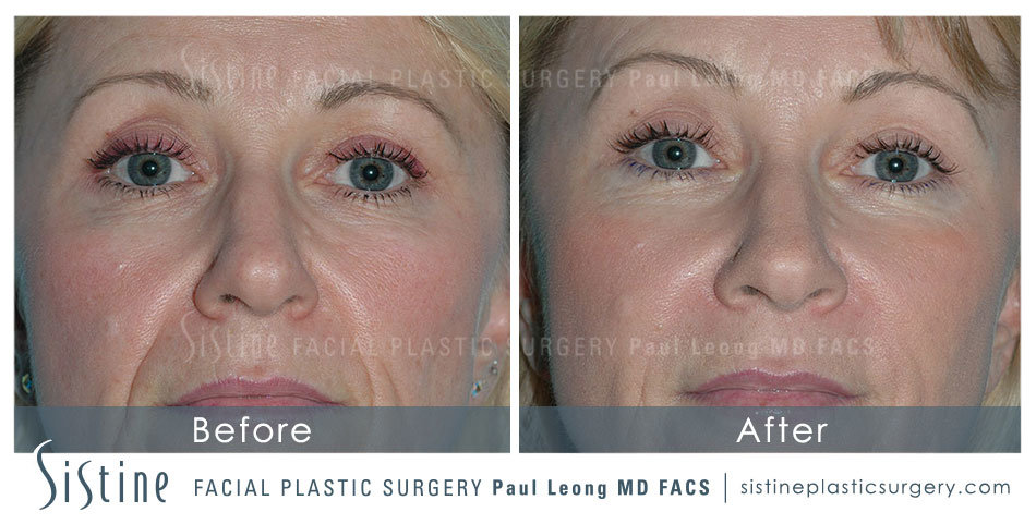 Botox Cosmetic Dysport Before and After | Leong Facial Plastic Surgery