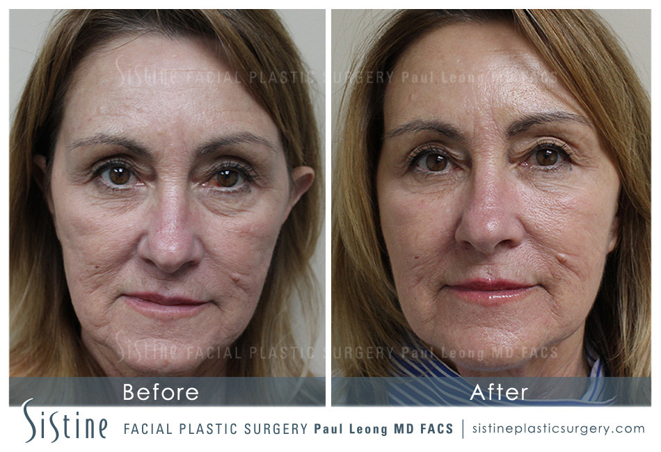 Botox Cosmetic Dysport Before and After | Leong Facial Plastic Surgery