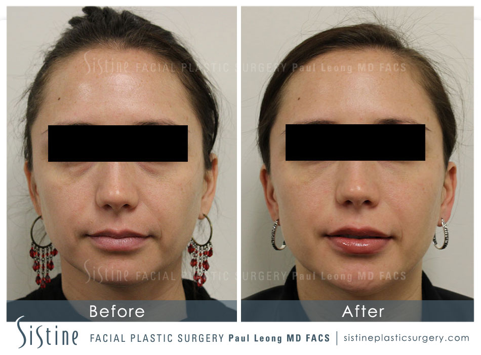 Botox Cosmetic Dysport Before and After | Leong Facial Plastic Surgery