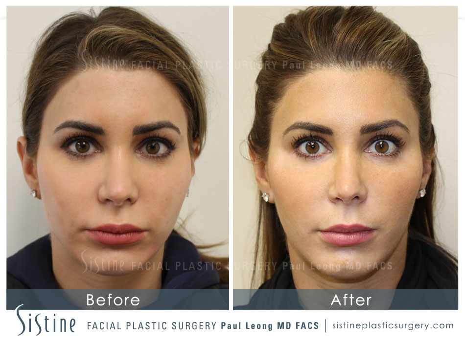 Botox Cosmetic Dysport Before and After | Leong Facial Plastic Surgery