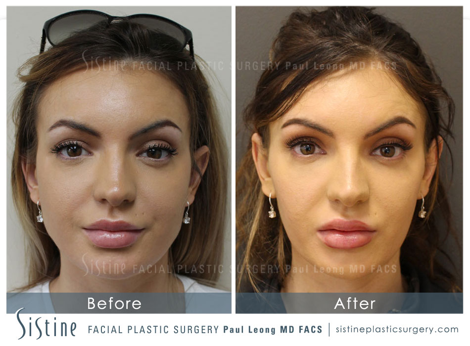 Botox Cosmetic Dysport Before and After | Leong Facial Plastic Surgery