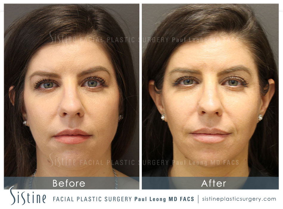 Botox Cosmetic Dysport Before and After | Leong Facial Plastic Surgery