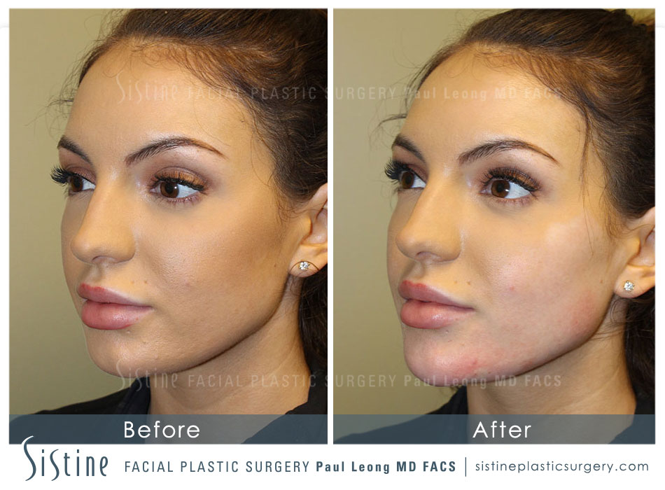 Chin Augmentation Before and After | Leong Facial Plastic Surgery