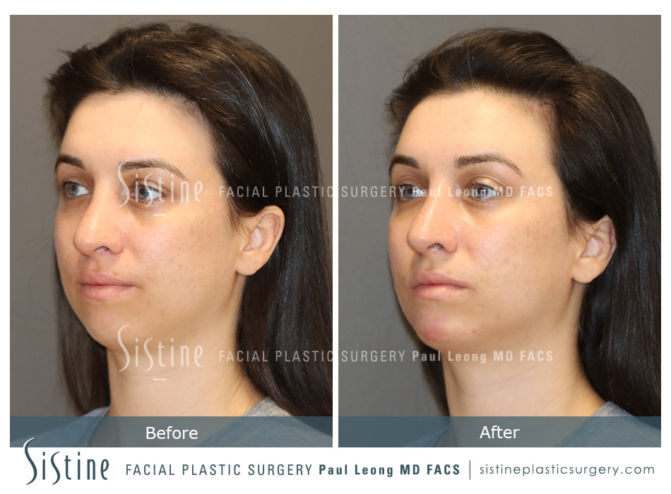 Dermal Fillers Before and After | Leong Facial Plastic Surgery