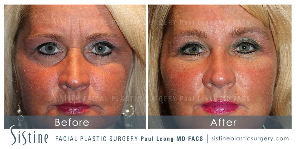 Dermal Fillers Before and After | Leong Facial Plastic Surgery