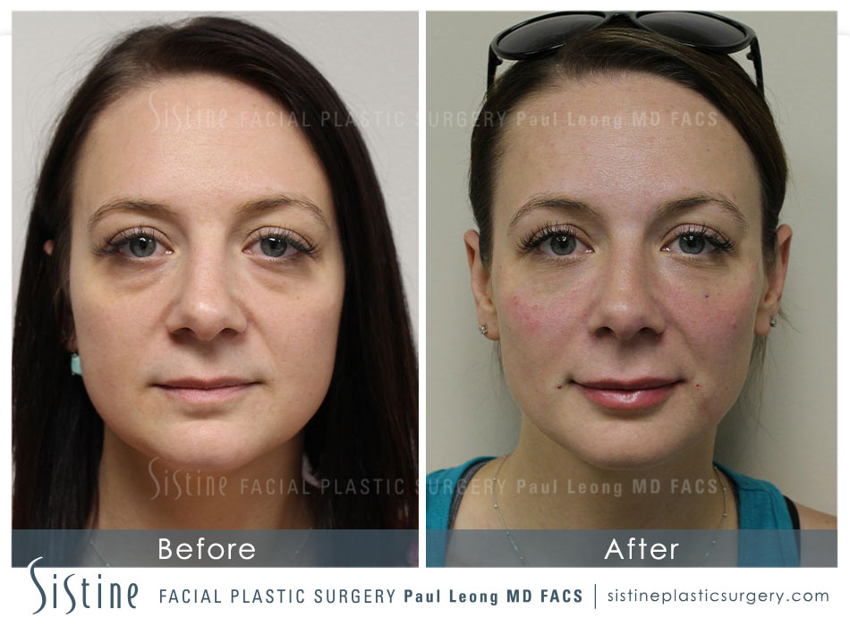 Dermal Fillers Before and After | Leong Facial Plastic Surgery