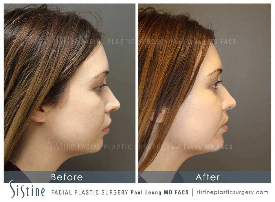 Dermal Fillers Before and After | Leong Facial Plastic Surgery