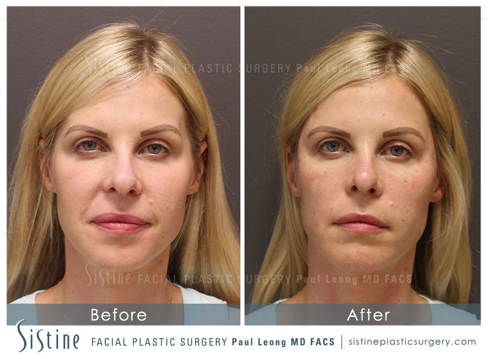 Dermal Fillers Before and After | Leong Facial Plastic Surgery