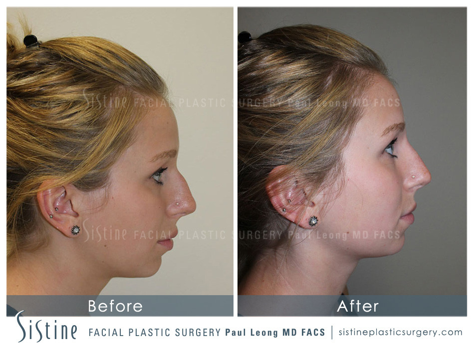 Dermal Fillers Before and After | Leong Facial Plastic Surgery