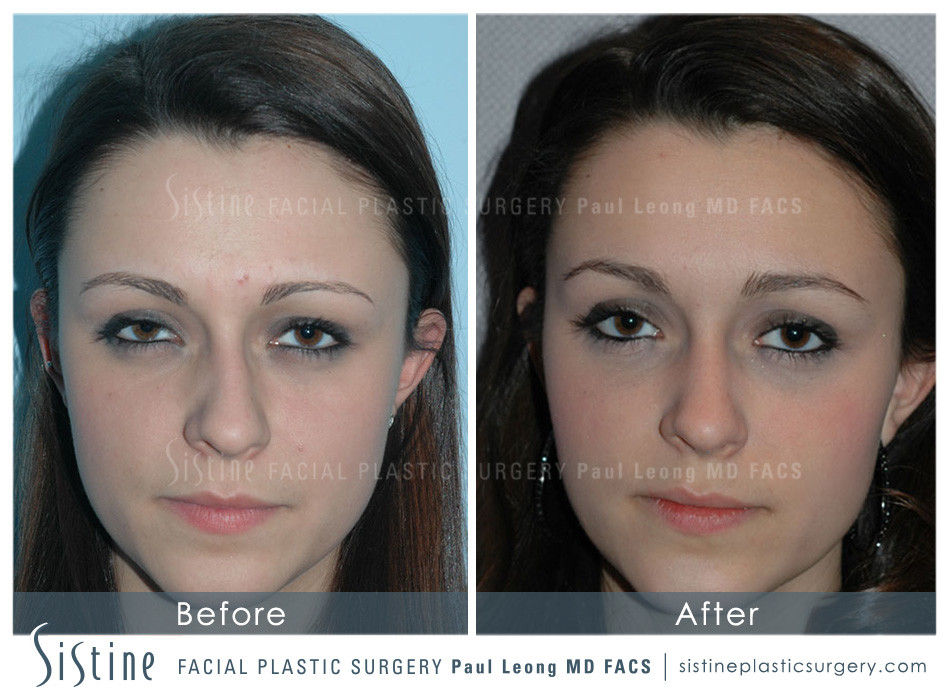 Dermal Fillers Before and After | Leong Facial Plastic Surgery