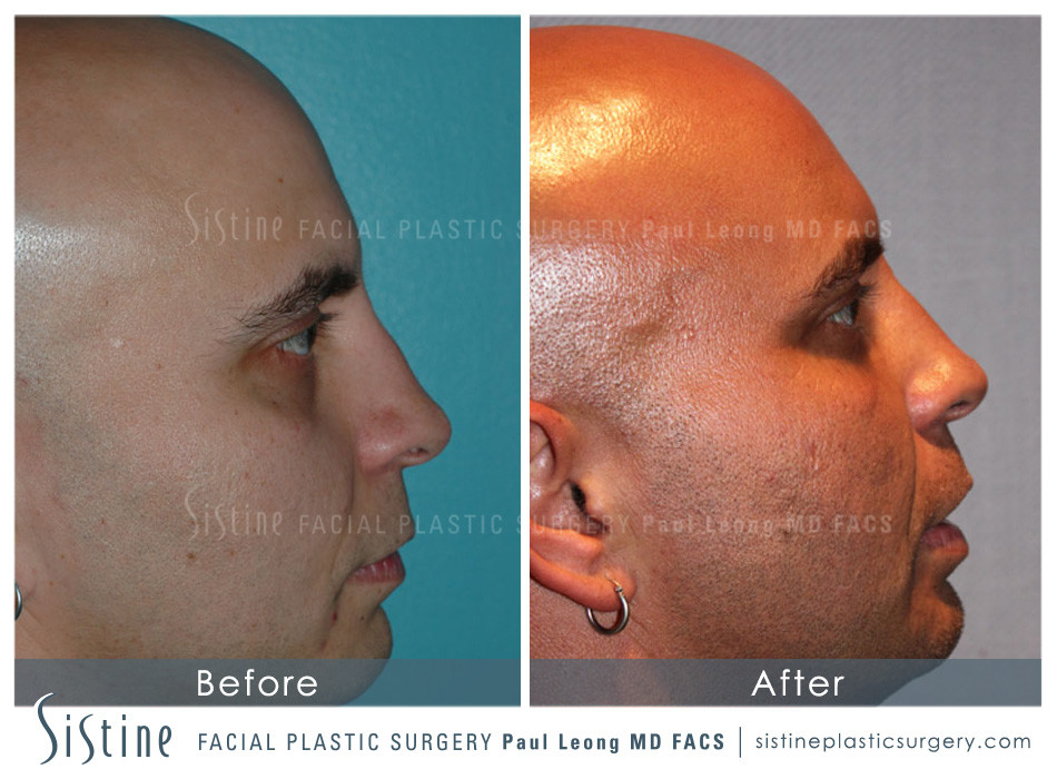 Dermal Fillers Before and After | Leong Facial Plastic Surgery