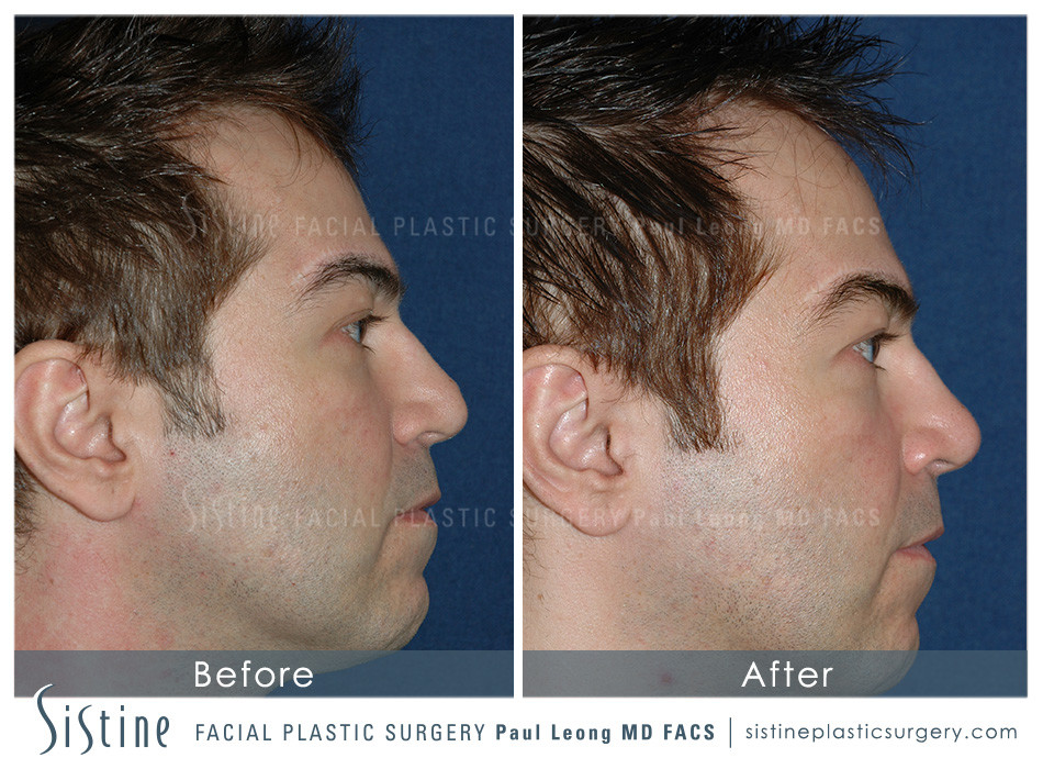 Dermal Fillers Before and After | Leong Facial Plastic Surgery