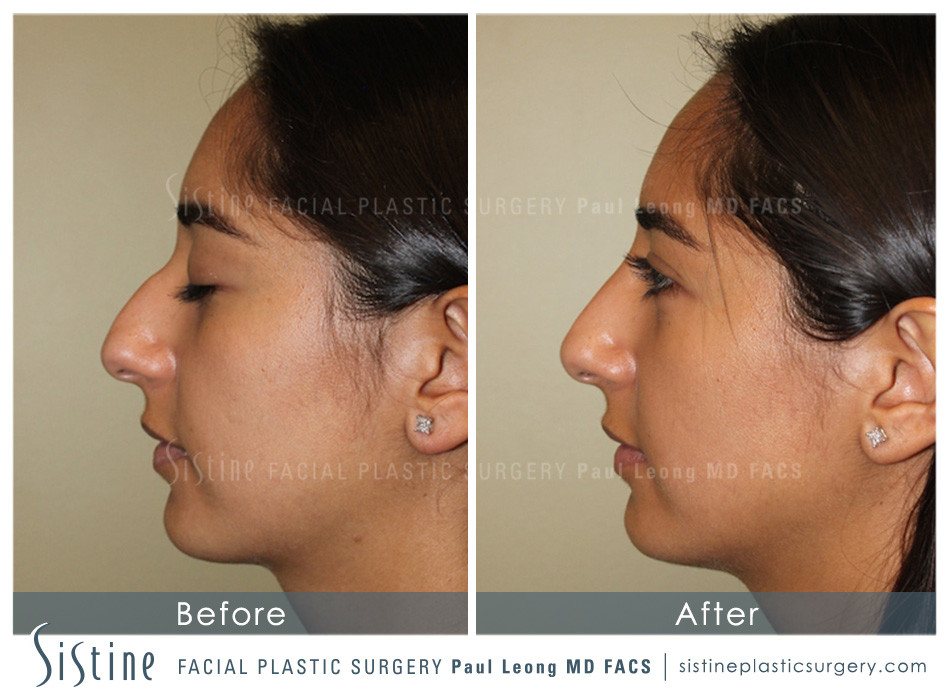 Dermal Fillers Before and After | Leong Facial Plastic Surgery