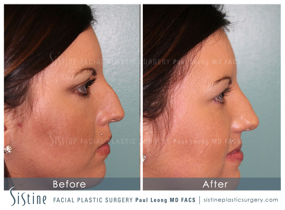 Dermal Fillers Before and After | Leong Facial Plastic Surgery