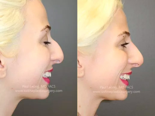 Dermal Fillers Before and After | Leong Facial Plastic Surgery