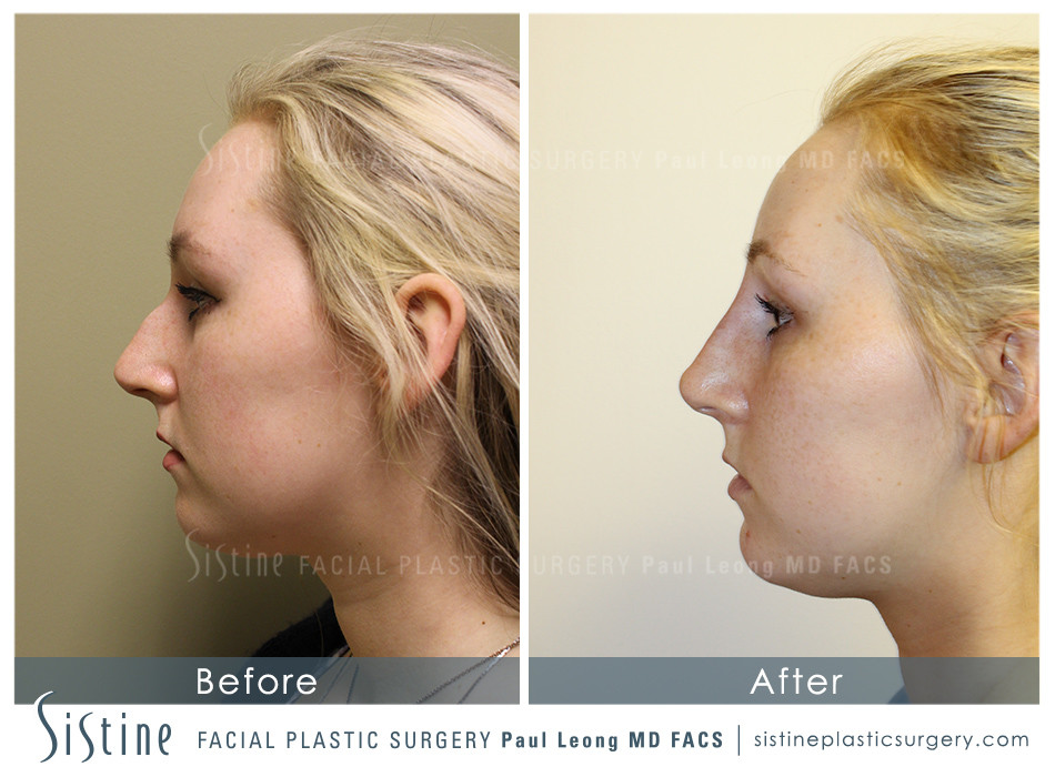 Dermal Fillers Before and After | Leong Facial Plastic Surgery