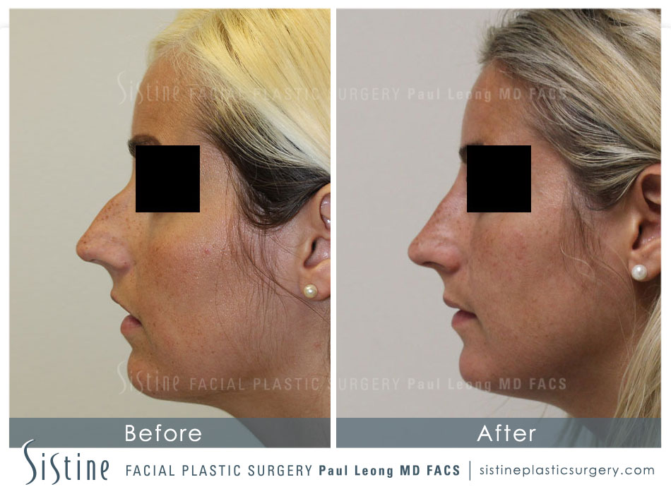 Dermal Fillers Before and After | Leong Facial Plastic Surgery