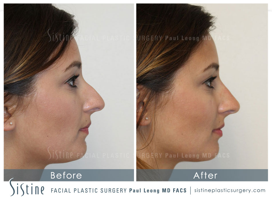 Dermal Fillers Before and After | Leong Facial Plastic Surgery