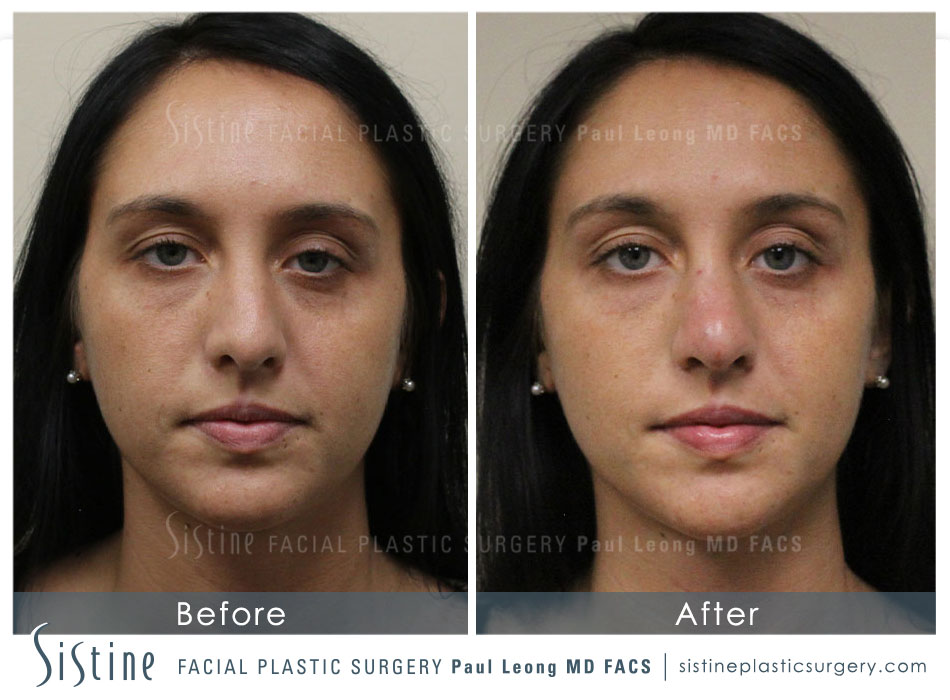 Dermal Fillers Before and After | Leong Facial Plastic Surgery