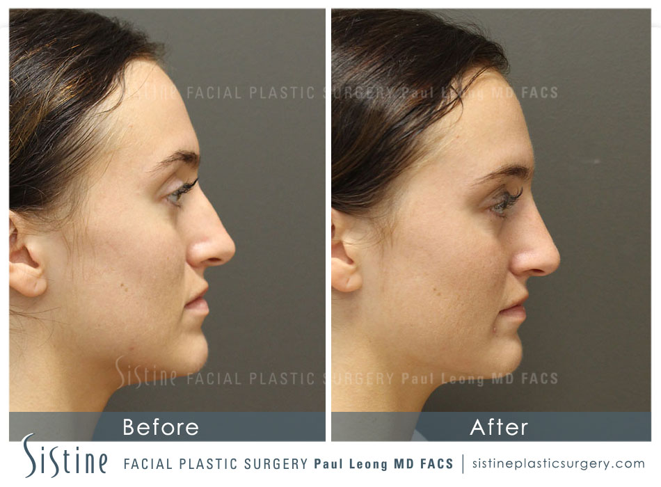 Dermal Fillers Before and After | Leong Facial Plastic Surgery