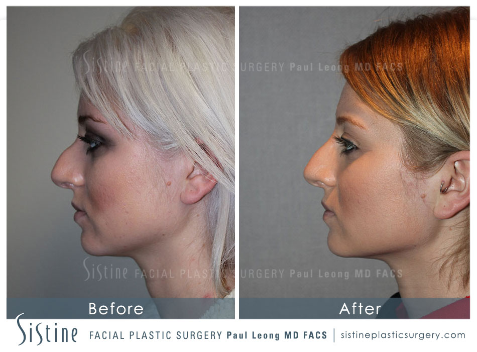 Dermal Fillers Before and After | Leong Facial Plastic Surgery