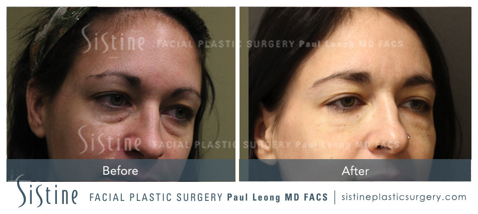 Dermal Fillers Before and After | Leong Facial Plastic Surgery