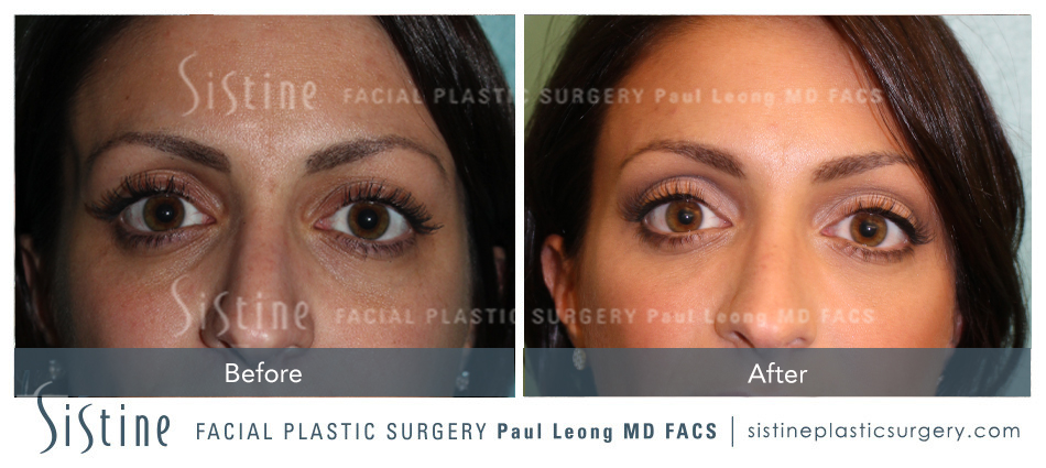 Dermal Fillers Before and After | Leong Facial Plastic Surgery