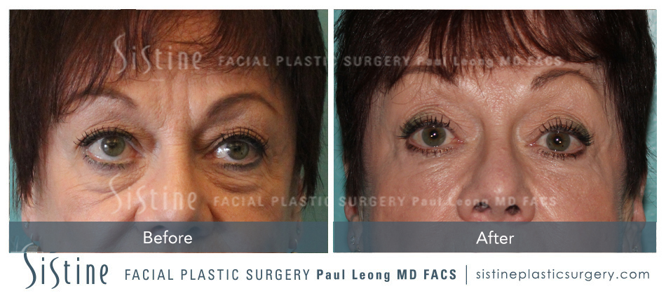 Dermal Fillers Before and After | Leong Facial Plastic Surgery